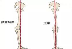 什么是膝盖超伸呢（膝盖超伸怎么解决）