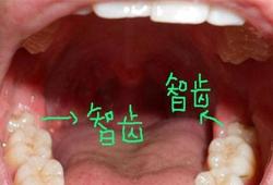 不长智齿是不是不正常 什么情况下不需要拔智齿