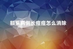 额头两侧长痘痘怎么消除（额头两侧长痘痘的原因及消除方法）